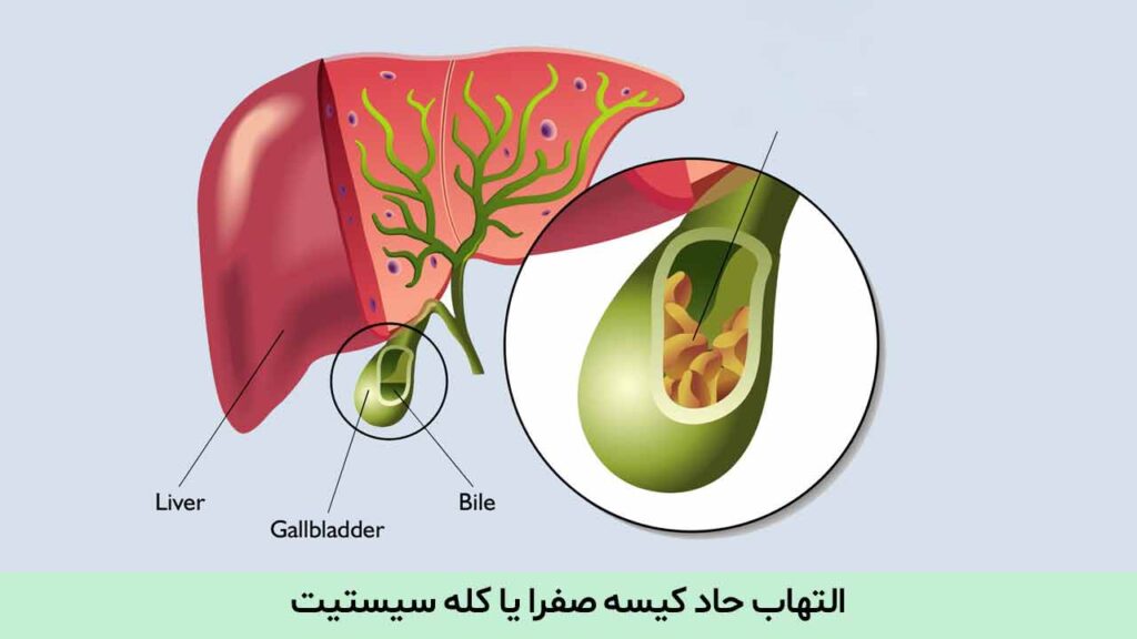 التهاب حاد کیسه صفرا یا کله سیستیت