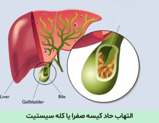 التهاب حاد کیسه صفرا یا کله سیستیت