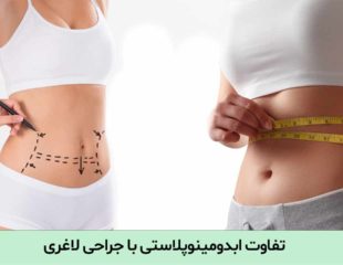 تفاوت ابدومینوپلاستی با جراحی لاغری