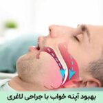 آپنه خواب