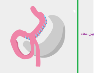 جراحی ساسی بای پس معده
