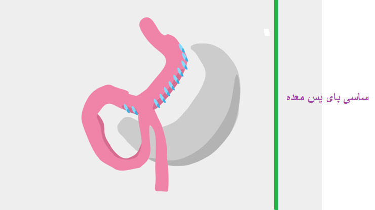 جراحی ساسی بای پس معده