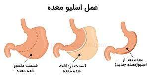 اسلیو معده و بارداری