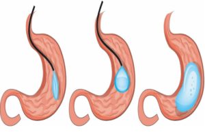 عمل های لاغری جدید ، بالون گذاشتن در معده