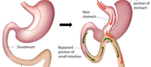 عمل لاغری معده در تهران، بای پس معده
