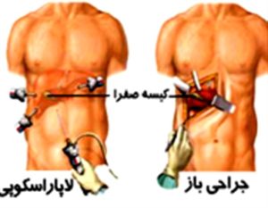 عمل لاغری معده در تهران، تفاوت جراحی باز و لاپاراسکوپی