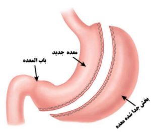 عمل لاغری معده در تهران، جراحی اسلیو معده