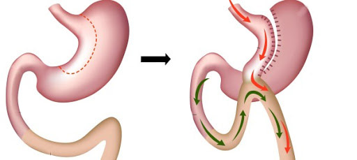 جراحی بای پس معده