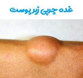 لاغری پهلو، چربی زیرپوستی