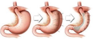 جراحی لاغری پلیکاسیون معده