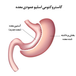 عمل‌های بی‌خطر لاغری، گاسترکتومی اسلیو