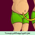 عمل لاغری لیپوساکشن