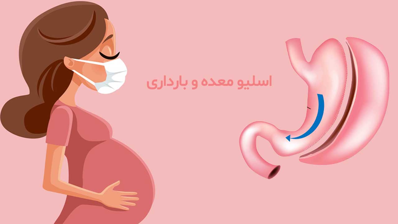 اسلیو معده و بارداری - dr-abdo روش های اسلیو معده و بارداری دکتر عبدو
