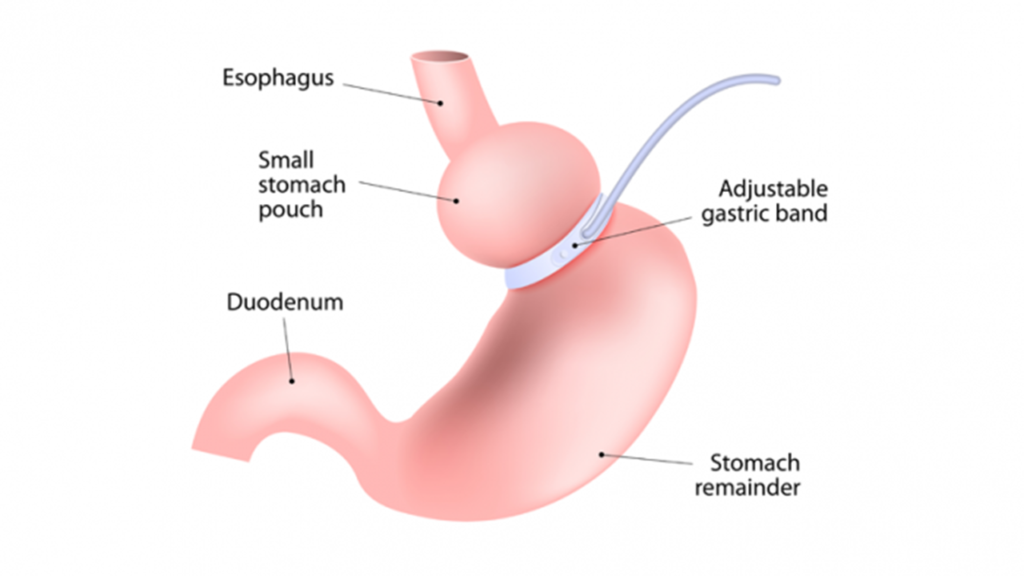 جراحی باند معده