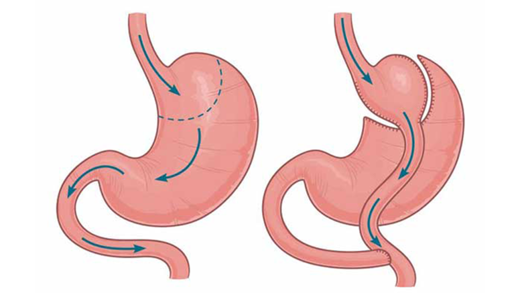 جراحی بای پس معده