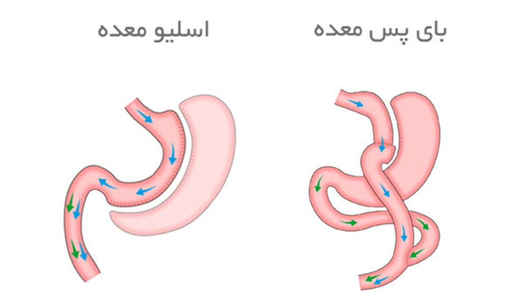 تفاوت جراحی اسلیو معده و بای پس معده