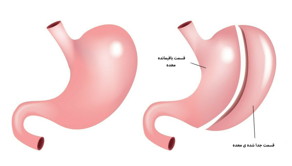 جراحی اسلیو معده