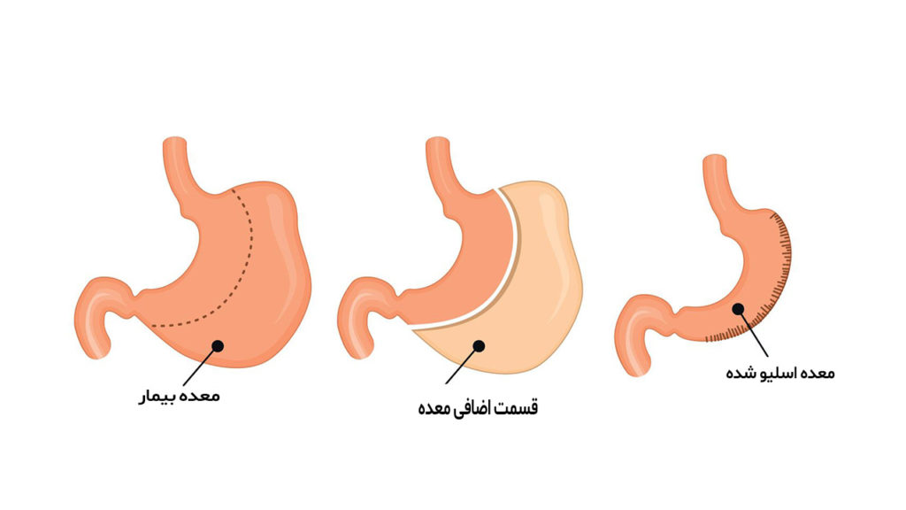 عمل اسلیو معده