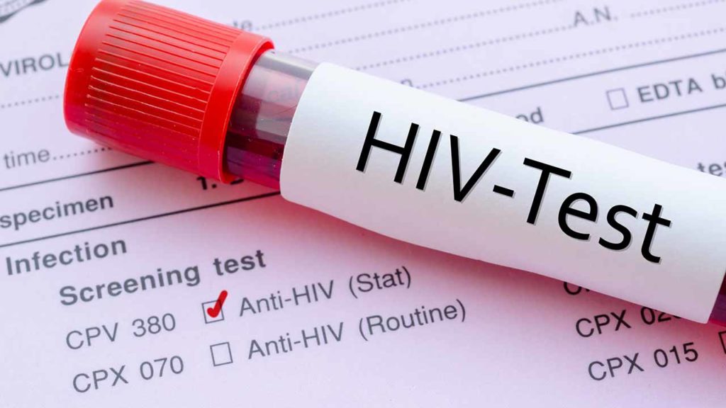 آزمایش HIV