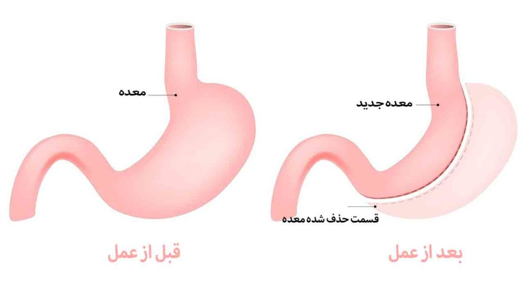 اسلیو معده