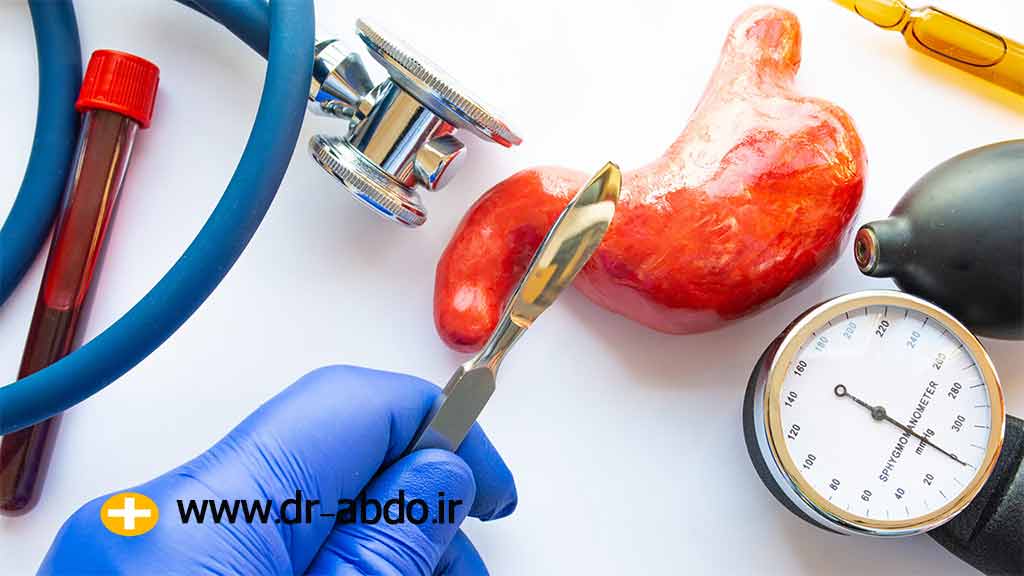 اسلیو معده چیست؟
