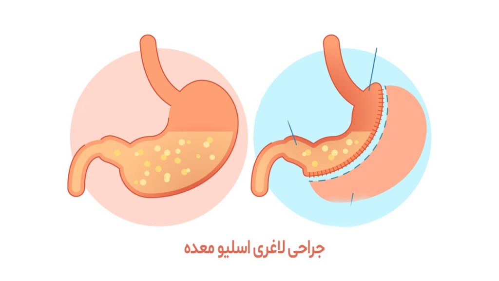 عمل اسلیو معده