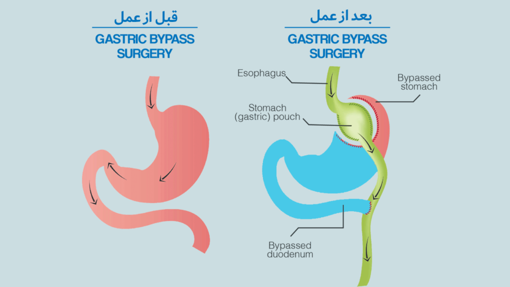 عمل لاغری بای پس معده