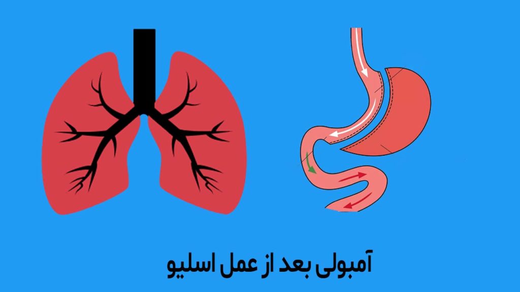 آمبولی بعد از اسلیو معده