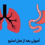 آمبولی بعد از اسلیو معده