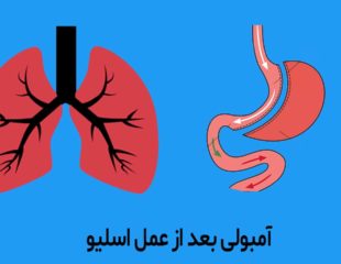 آمبولی بعد از اسلیو معده