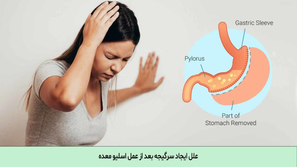 سرگیجه بعد از عمل اسلیو معده