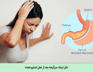 سرگیجه بعد از عمل اسلیو معده