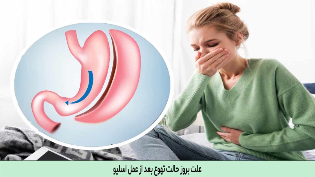 علت بروز حالت تهوع بعد از عمل اسلیو