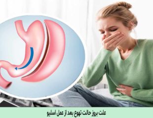 علت بروز حالت تهوع بعد از عمل اسلیو