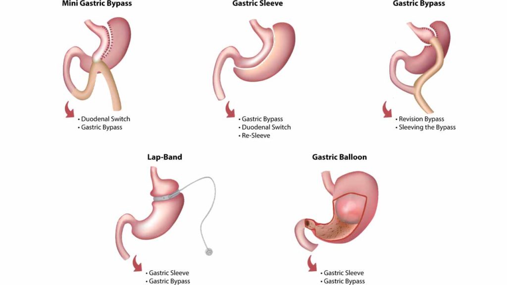 نوع جراحی لاغری
