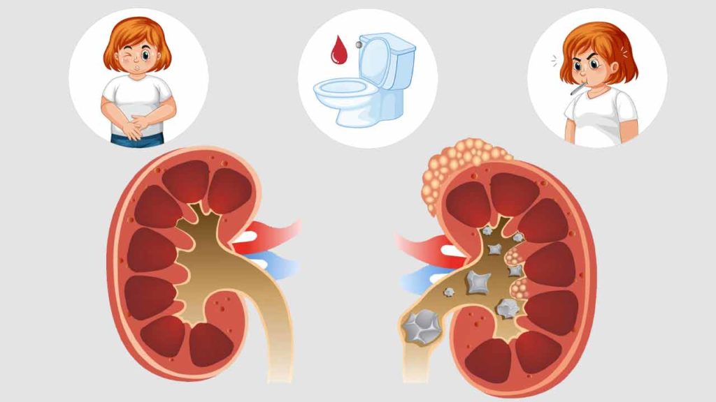 چگونگی ایجاد سنگ کلیه