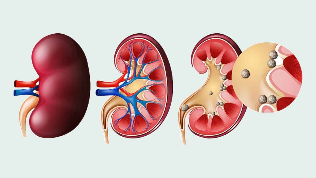تشخیص سنگ کلیه