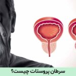 سرطان پروستات