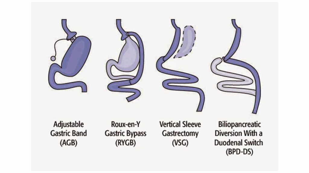 انواع جراحی لاغری