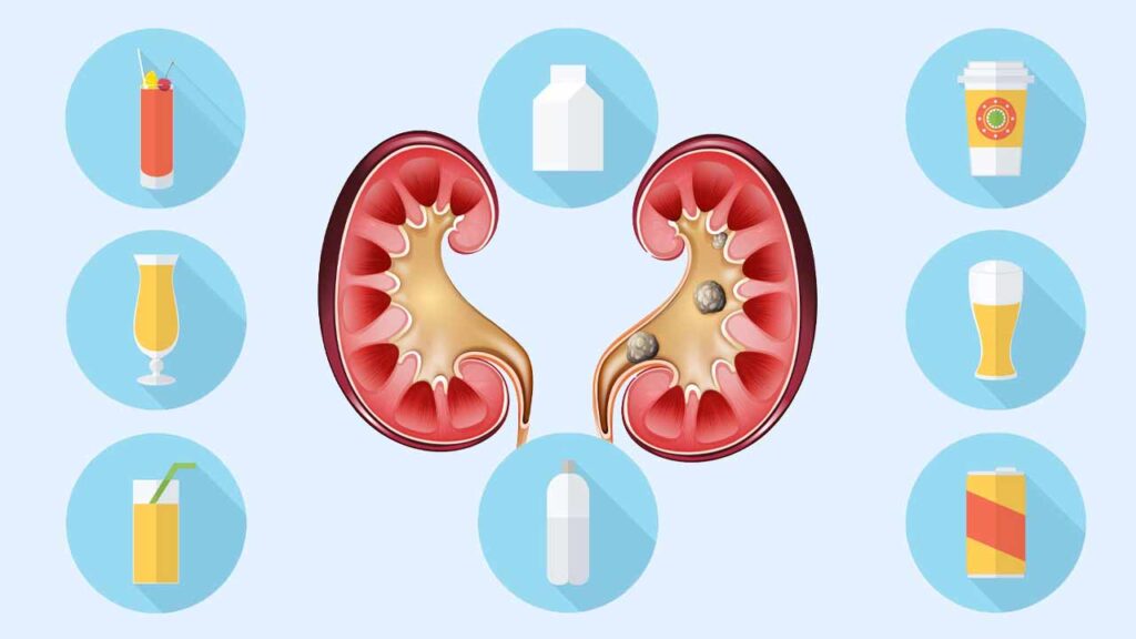 انواع نوشیدنی های مفید برای دفع سنگ کلیه