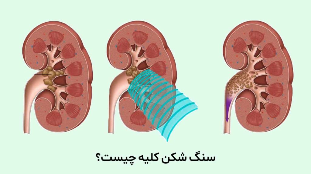 سنگ شکن کلیه چیست؟
