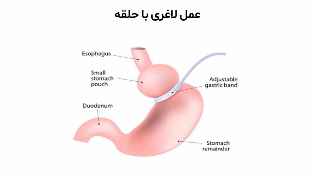 مزایای عمل لاغری با حلقه