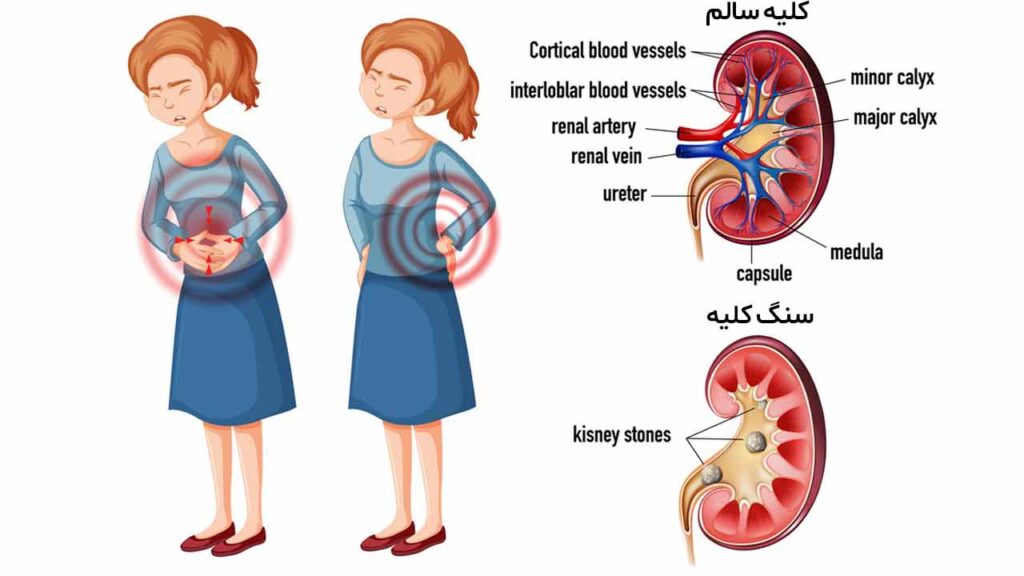 تشخیص سنگ کلیه