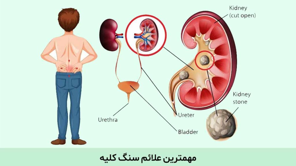 علائم سنگ کلیه