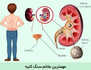 علائم سنگ کلیه