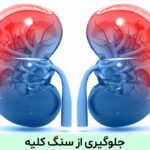 جلوگیری از سنگ کلیه