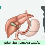 بازگشت وزن بعد از عمل اسلیو