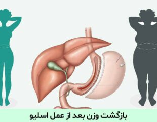 بازگشت وزن بعد از عمل اسلیو