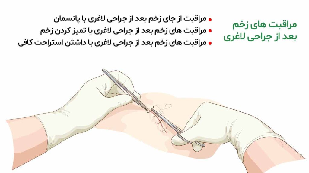 مراقبت های زخم بعد از جراحی لاغری