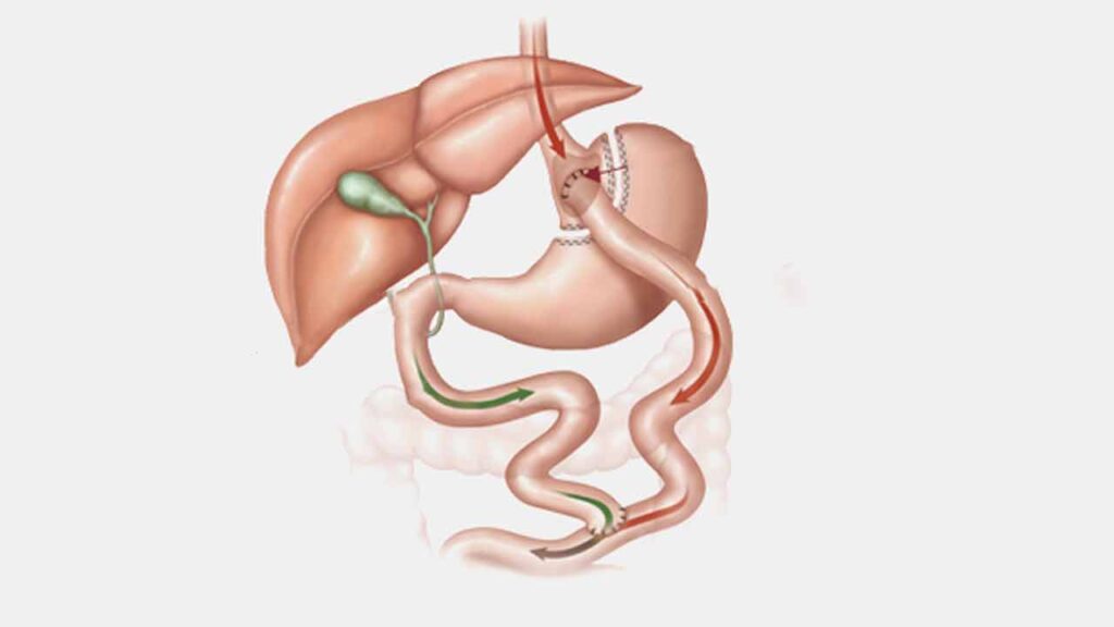جراحی بای پس معده